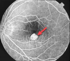 Histoplasmosis Louisville Ky Eye Surgery Florence