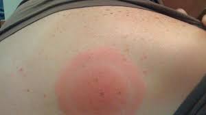 Manifestri multisistemice (cutanate, articulare, neurologice, cardiace) determinat de spirocheta aparinnd genului borrelia. In Ultimii Ani Tot Mai MulÈ›i Moldoveni Au Fost DiagnosticaÈ›i Cu Boala Lyme TransmisÄƒ De CÄƒpuÈ™e