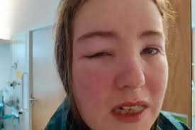 Yate mum speaks of daughter's 'awful' health battle six years after  mosquito bite