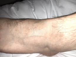Kleine Rote Punkte Fuss Haut Dermatologie