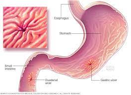 Peptic Ulcer - Symptoms And Causes - Mayo Clinic