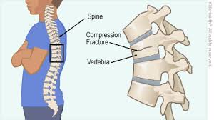 These vertebrae bear much of the body's weight and related biomechanical stress. Compression Fracture Of The Spine For Parents Nemours Kidshealth