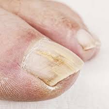 Topical Treatment Options For Toenail Fungus