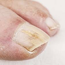 topical treatment options for toenail