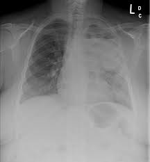 Knowing which type of lung cancer you have will help your doctors to stage the tumor accurately and to begin identifying the best treatment approach. Lung Carcinoma Pulmonary Disorders Msd Manual Professional Edition