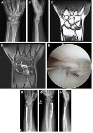 Ulnar Impaction Syndrome: A Case Series And Imaging Approach