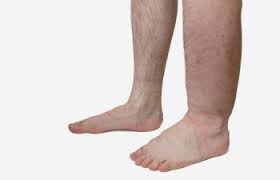 Blood clots can form in any deep veins of the body. Blood Clot Symptoms And How To Prevent Them New York Ny