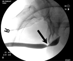 Image result for Retrograde Urethrogram