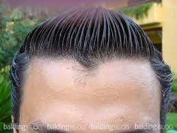 A widow's peak is a pointed section of hair at the middle of the hairline that is farther forward than the hairline to the sides. Forelocks And Widow S Peaks With Photos Wrassman M D Baldingblog