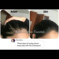Biotin Shampoo Before And After Men Hair Oil Formula D Hair Regrowth Serum For Fast Hair Growth Dht Blocker For Men And Women With Jamaican Black Castor Oil Hair Oil Formula Hair Regrowth Hair Regrowth Serums