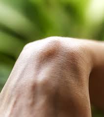 Milia are small, yellow or white cysts that appear in clusters, usually on the face. 10 Home Remedies To Get Rid Of Ganglion Cysts Causes And Medical Treatment