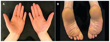 Pityriasis rubra pilaris is an uncommon skin condition. Acral Pityriasis Rubra Pilaris Cmaj