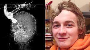 Catastrophic' Hammer-Attack Injuries Revealed