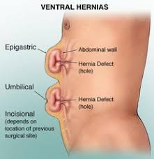 As the abdominal muscles are hard to support externally, treatment involves rest. Abdominal Muscles Physiopedia