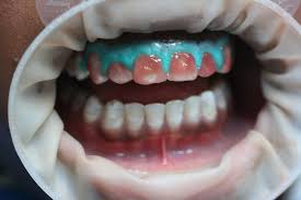 Mein zahnarzt hat mir die harmonieschiene vorgeschlagen, welche nach dem gleichen prinzip arbeitet. Bleaching Dr Holscher Frankfurt Zahnarzt