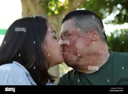 War injuries afghanistan hi-res stock photography and images