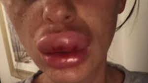 Lip Injection At Botox Party Goes Horribly Wrong Youtube Because lip skin is so thin and sensitive, any number of issues could result in that telltale puffy, uncomfortable. lip injection at botox party goes horribly wrong