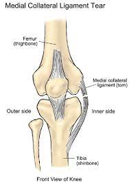 Grade iii tears are also usually treated conservatively unless associated with injuries to the anterior cruciate ligament or posterior cruciate ligament. Mcl Injury Active Care Physiotherapy Clinic