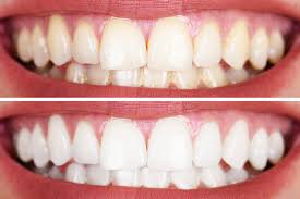 Teeth whitening + after braces q&a. Brighten Your Smile With Effective Teeth Straightening Procedures Im Sharing This Link