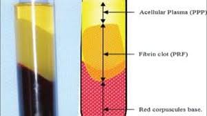 Your abbreviation search returned 61 meanings. Prf In Wisdom Tooth Removal And Dental Implant Surgery