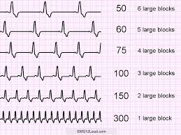 large block method for heart rate calculation ems 12 lead