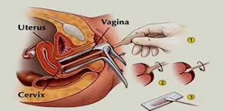 Denumirea de endometrioza deriva de la cuvantul endometru, care reprezinta mucoasa care captuseste cavitatea uterina. Recoltarea SecreÅ£iilor Cervico Vaginale Pentru Examene De Laborator Sanatatea Info