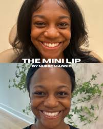 LIP FILLER + LIP FLIP = THE ULTIMATE DUO Subtle plump + lifted definition  💋 This combo enhances volume while softening a gummy smile and helping the  upper lip sit just right —