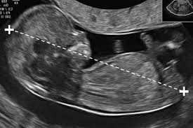 Image result for First Trimester Ultrasound