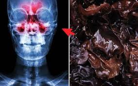 Últimas noticias sobre hongo negro. Hongo Negro Que Es Y Quienes Estan En Riesgo De Contraerlo El Sol De San Luis Noticias Locales Policiacas Sobre Mexico San Luis Potosi Y El Mundo