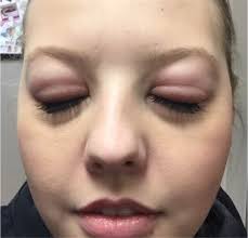 Allergic Reactions To Eyelash Extensions Eyelash Extensions Eyelash Extentions Eyelash Extensions Care