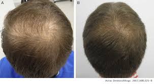 Mammalian hair cells and auditory neurons do not show regenerative capacity. New Treatments For Hair Loss Actas Dermo Sifiliograficas
