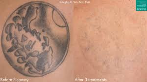 Results after one treatment photo 3: Laser Tattoo Removal Medical Spa San Diego Ca Clderm