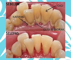 Ada banyak cara mudah menghilangkan dan membersihkan karang gigi membandel. Jum Cuci Gigi Murah Murah 10 00 Klinik Pergigian Azira Facebook