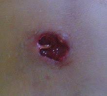 These med pods can be installed virtually anywhere as they do not require much power to operate. Abscess Wikipedia