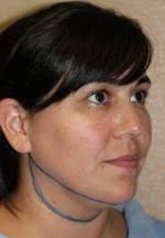 Neck Lift Before and After Photos