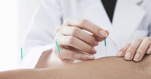 Acupuncture is a traditional chinese therapy based on sticking needles into the dermis at precise points. Dry Needling Vs Acupuncture Benefits And Risks