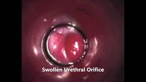 Female urethral discharge is usually the first sign of an infection known as urethritis. Otoscopic Urethral Catheterization Female Cat Urinary Tract Youtube