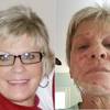 Sculptra aesthetic before and after image gallery. 1