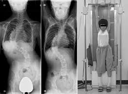 Hanging radiograph in idiopathic scoliosis patients: significance as a  preoperative stress X-ray