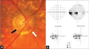New Directions In The Treatment Of Normal Tension Glaucoma Song Bj Caprioli J Indian J Ophthalmol Glaucoma is a common, complex, heterogenous disease and it constitutes the major cause of irreversible blindness worldwide. treatment of normal tension glaucoma