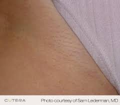 Dermatology associates of atlanta uses laser hair removal or electrolysis to remove hair from the face and body of men and women. Hi Tech Laser Hair Removal T Douglas Gurley Md