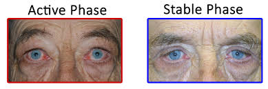 Thyroid Eye Disesase Patient Information