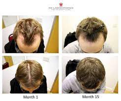 Revita Ds Healthcare Group Short Hair Styles Stop Hair Loss Hairstyles For Thin Hair