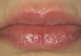 Obere Lippen Rand Rot Weg Bekommen Gesundheit Und Medizin Lippenpflege