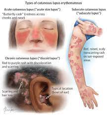 Women ages 15 to 44. Cutaneous Lupus Erythematosus Subacute Cutaneous Lupus Discoid Lupus Lupus Symptoms
