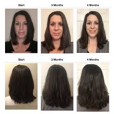 Getting a high level of stress hormone for a prolonged time can result in unwanted facial hair growth in women. Up Hair Growth System Stops Hair Loss Creates Fast New Growth