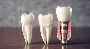Same-Day Dental Implants: Eligibility Explained