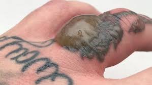 Alex williamson (@alexshooterwilliamson) on tiktok | 23.2m likes. Video Man Left With Massive Blister After Tattoo Laser Removal Daily Mail Online