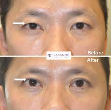 Temporal lift before and after patient 7: Asian Blepharoplasty Beverly Hills Double Eyelid Surgery Los Angeles
