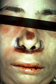 Mucormycosis (zygomycosis) is a fungal infection caused by zygomycetes. Cutaneous Mucormycosis Mucormycosis Zygomycetes Dermatology Advisor